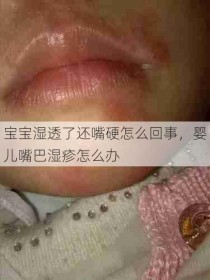 宝宝湿透了还嘴硬怎么回事，婴儿嘴巴湿疹怎么办