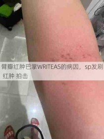 臂瓣红肿巴掌WRITEAS的病因，sp发刷 红肿 拍击